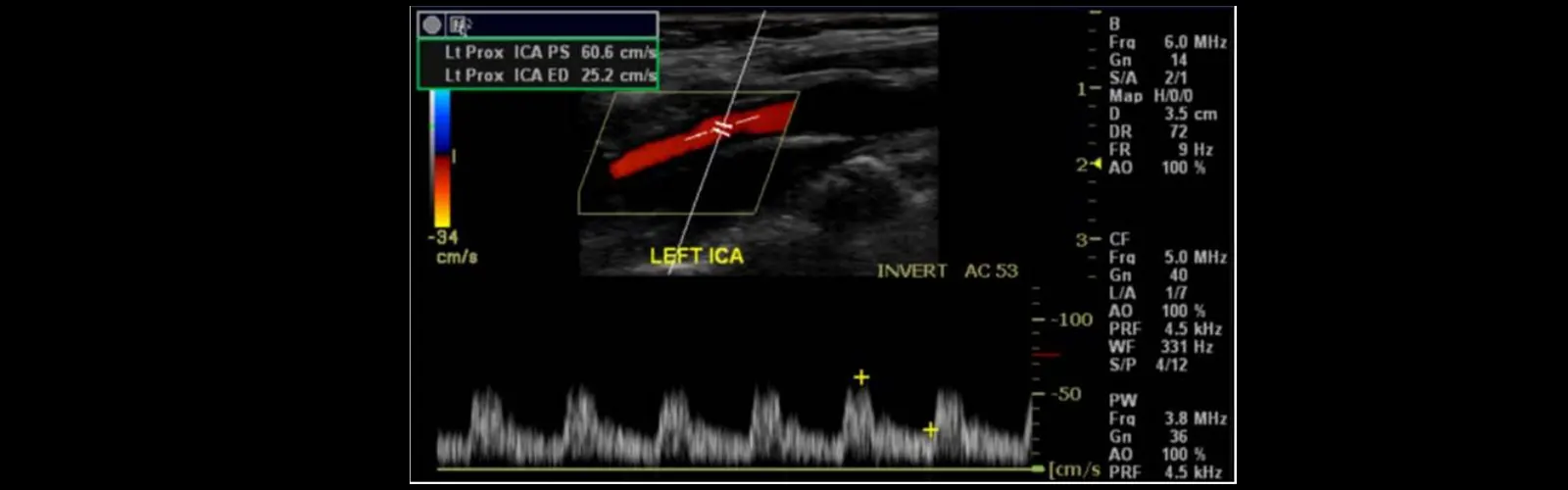 Why Is Carotid Color Doppler Ultrasound Done?